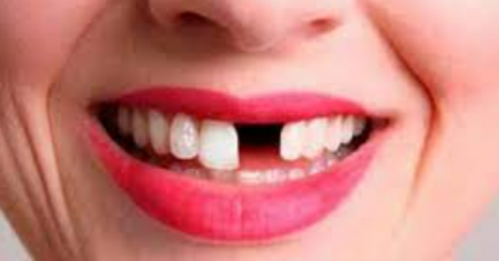 تفسير حلم سقوط الأسنان في اليد بدون ألم